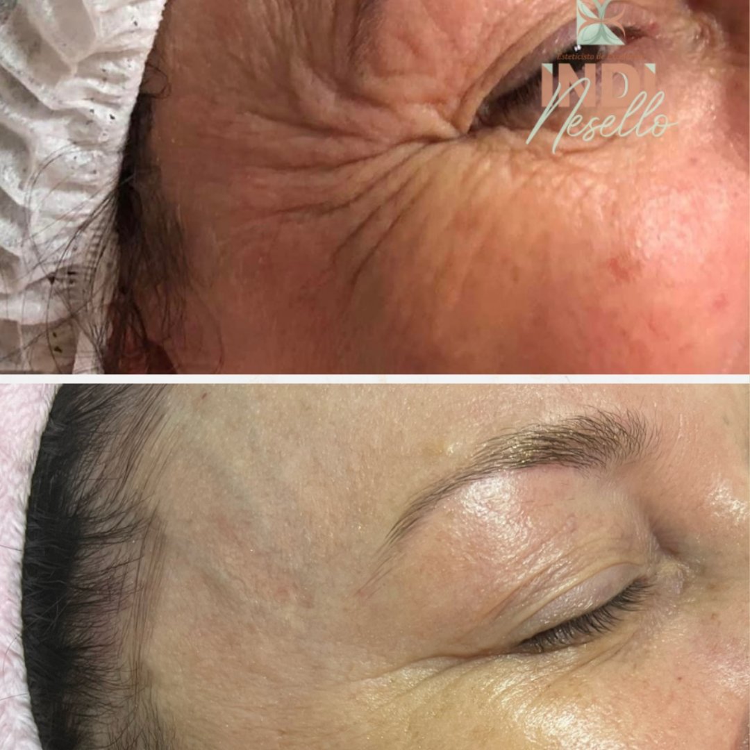 Botox (3)