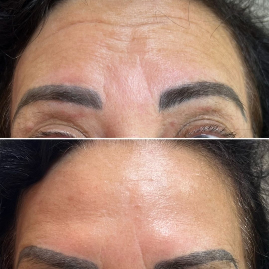 Botox (6)
