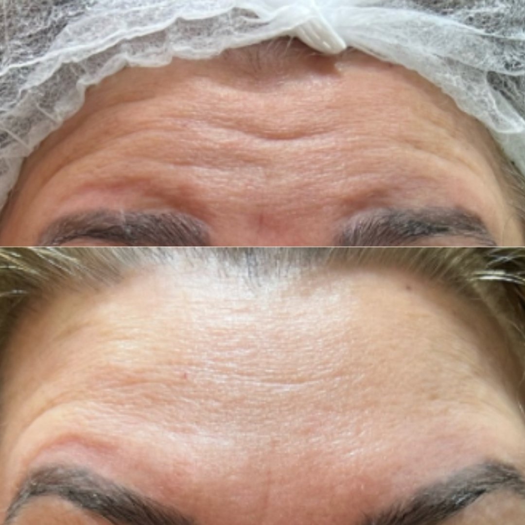 Botox (7)