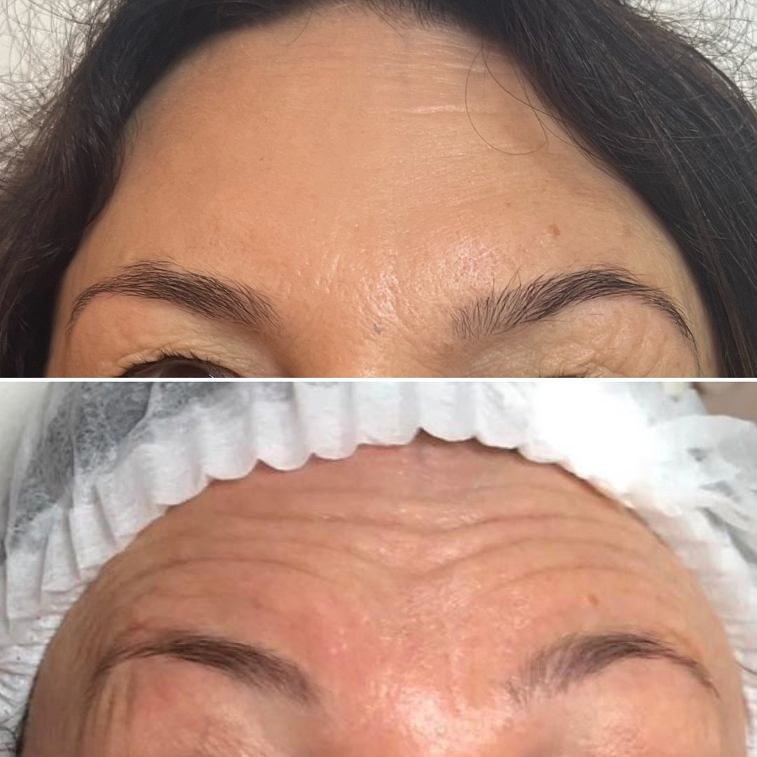 Botox