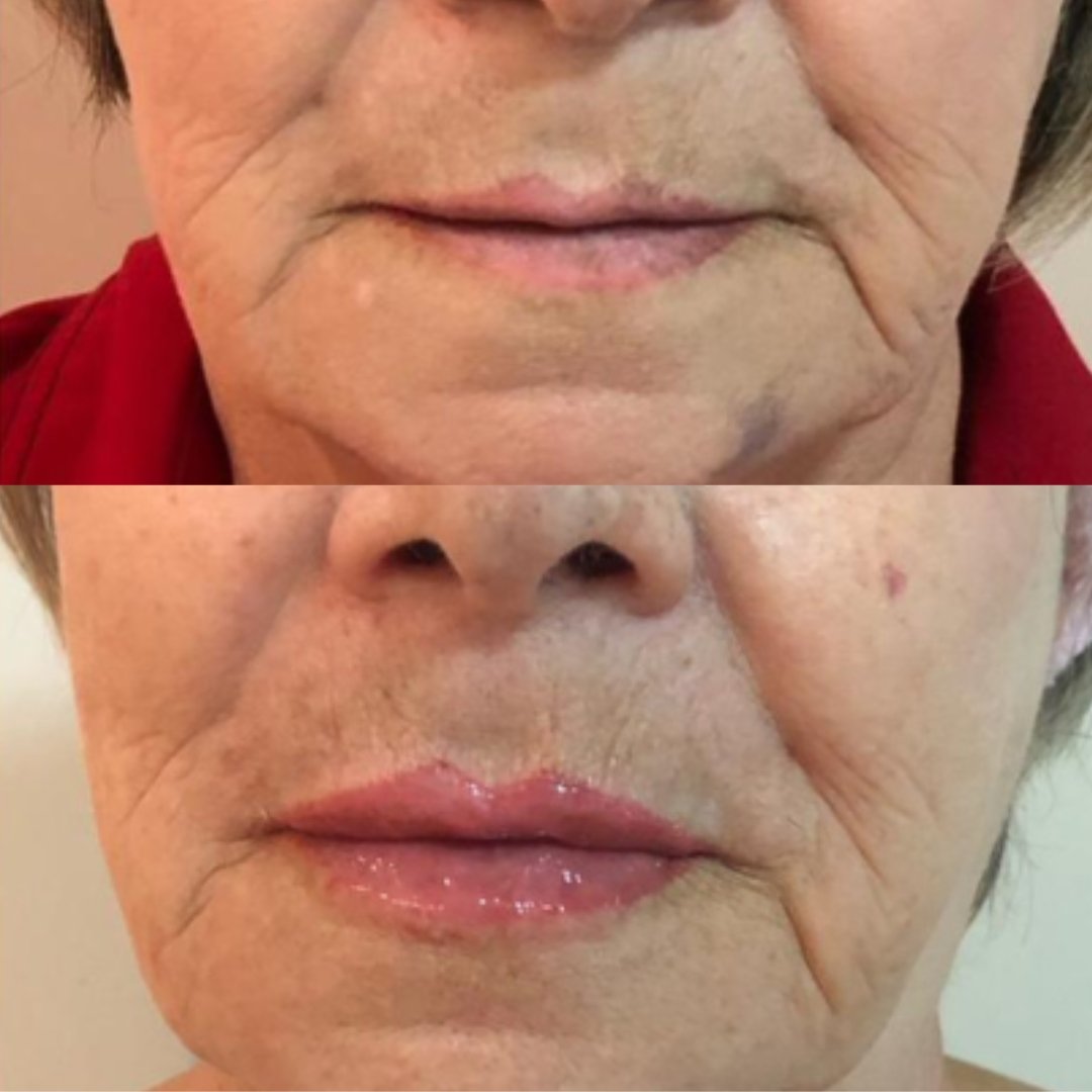 Preenchimento Labial (2)