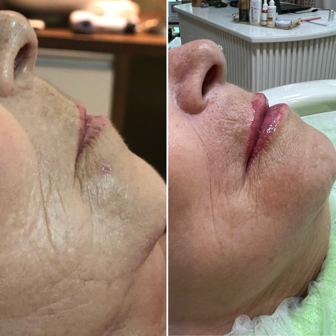 Preenchimento Labial (3)