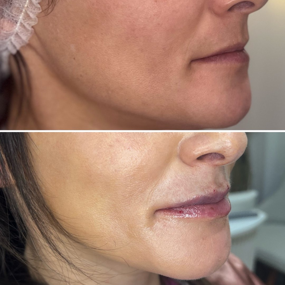 Preenchimento Labial (6)