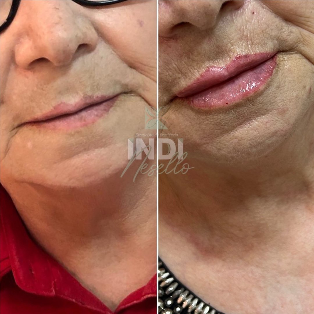 Preenchimento Labial (7)