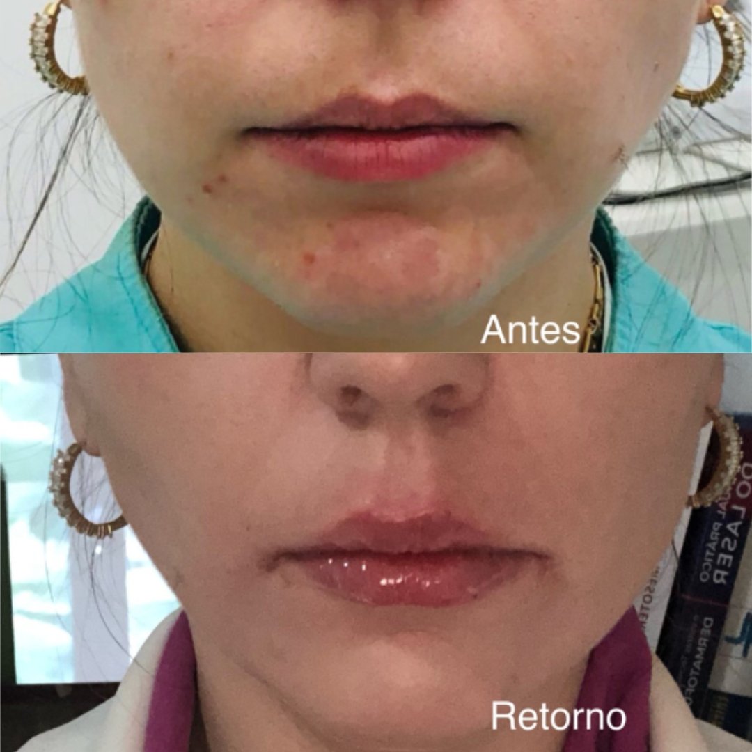 Preenchimento Labial